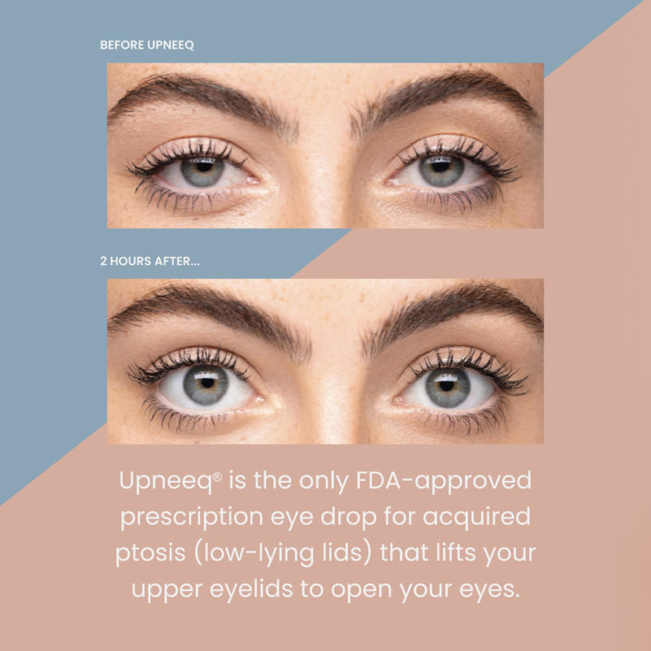 Upneeq Lifting Eye Drops » Binhlam Aesthetics » Nashville TN