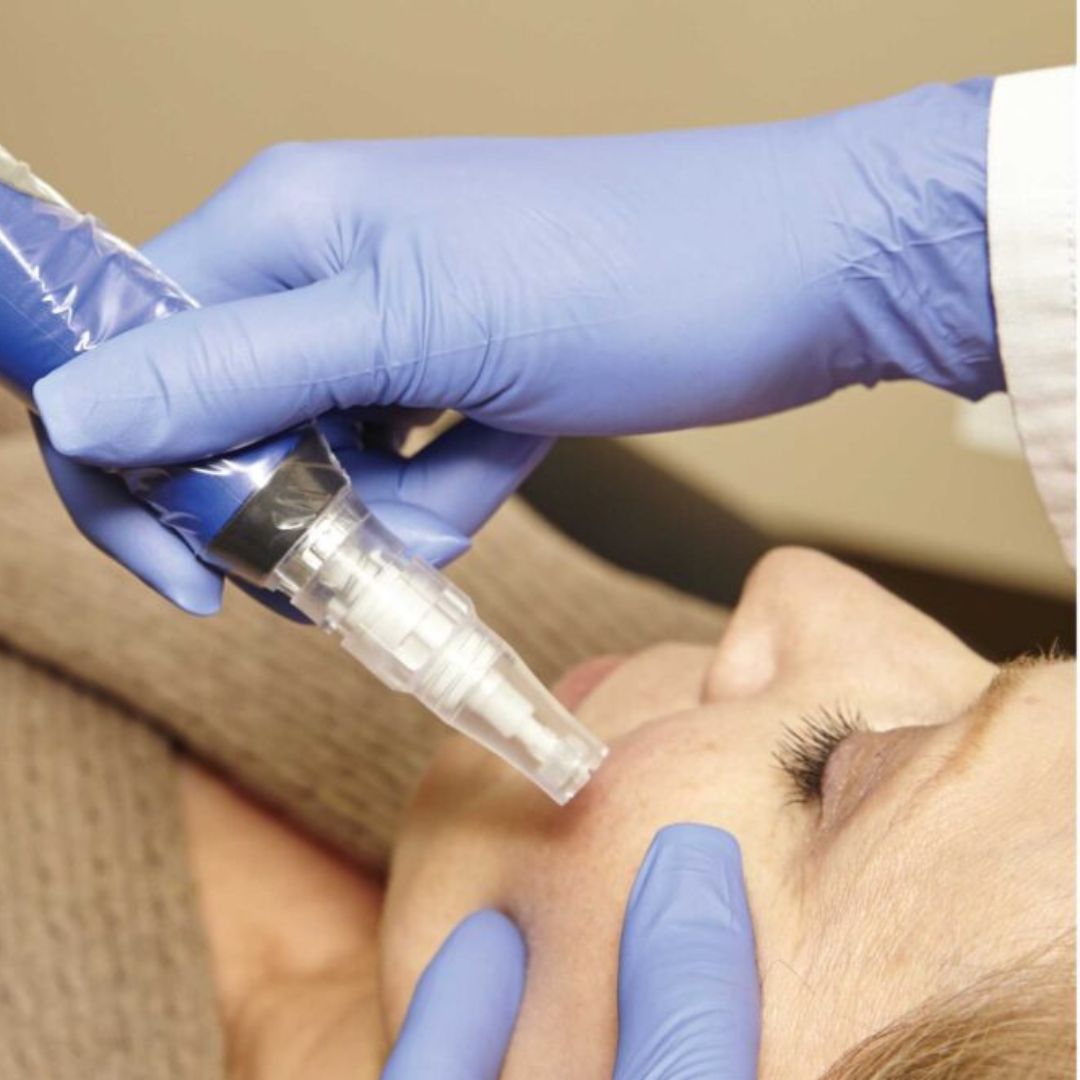 microneedling with prp in brentwood tennessee