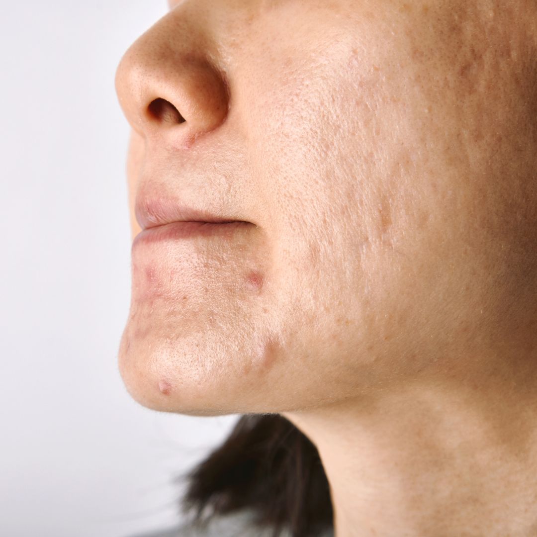 acne scar treatment nashville