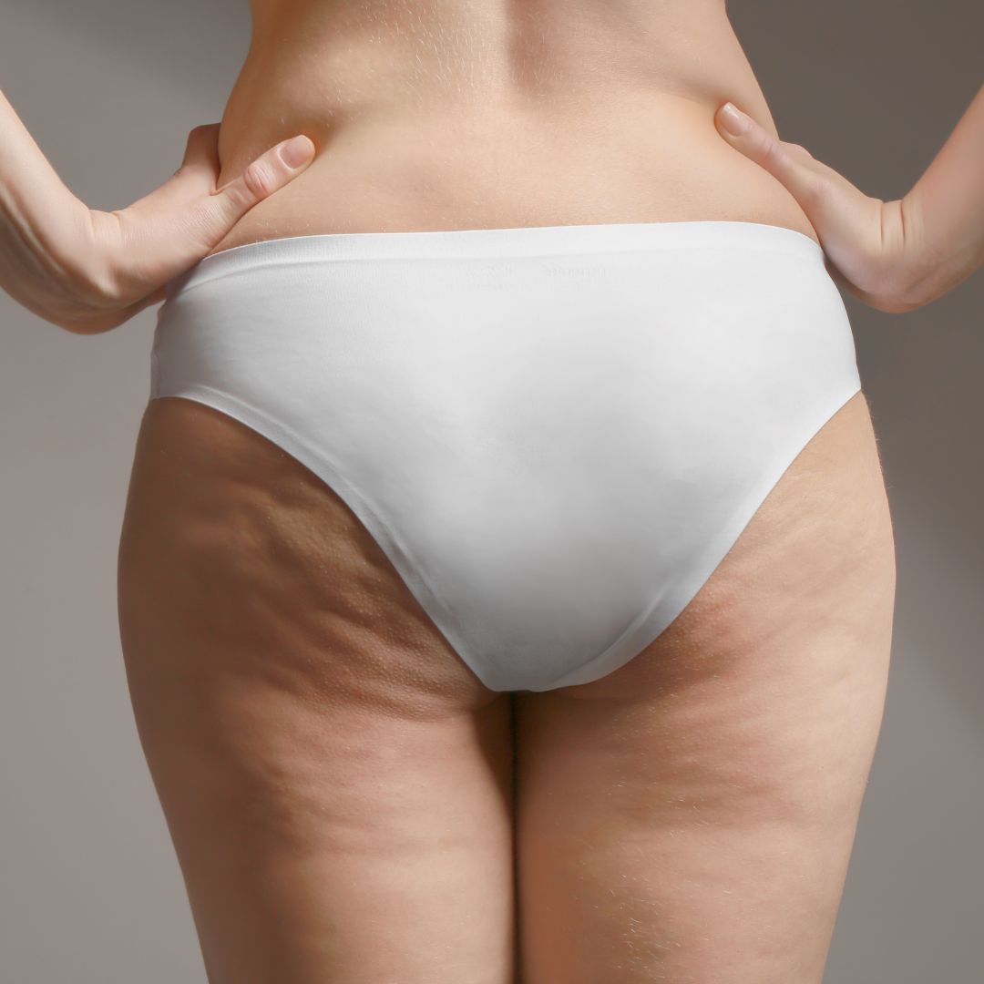cellulite treatment brentwood tn
