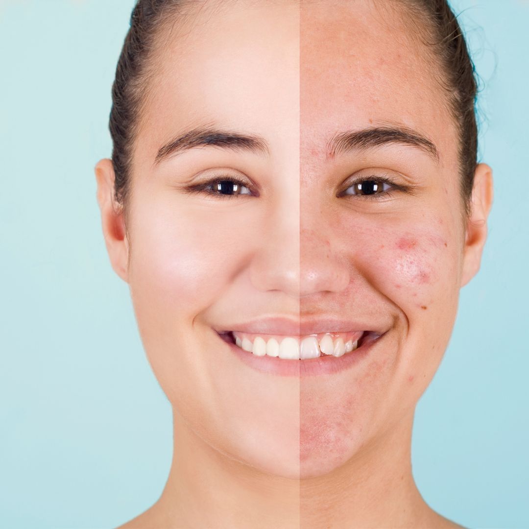 acne treatments in brentwood tn