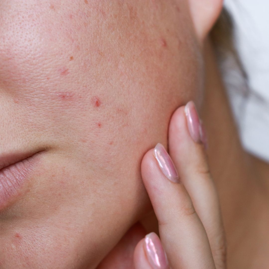 acne treatment in nashville