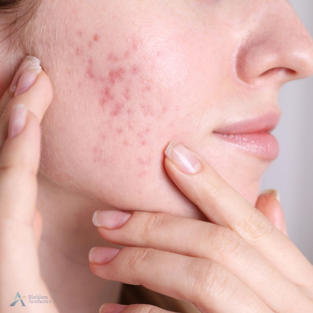 acne scar treatment in brentwood tn