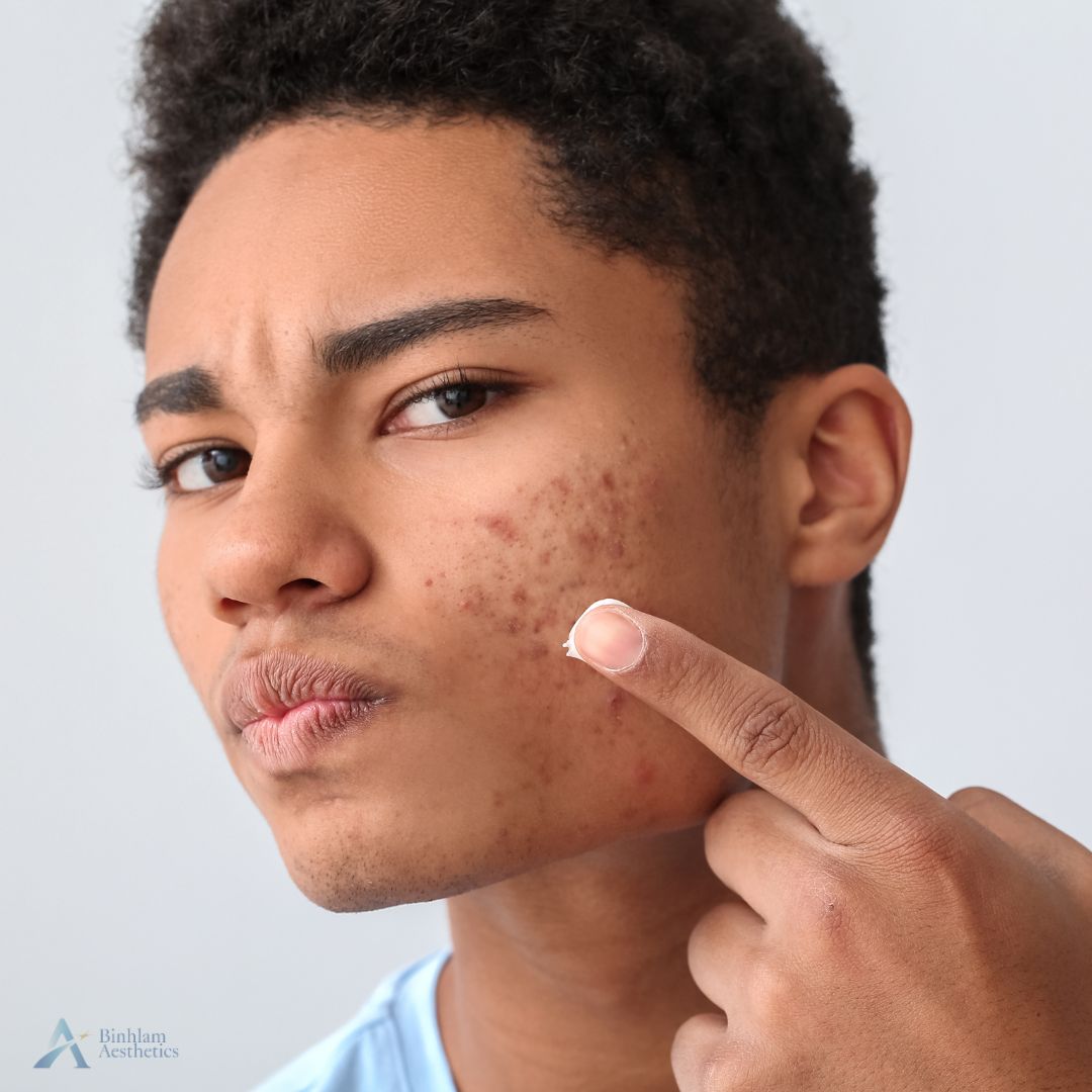 laser acne treatment in Nashville